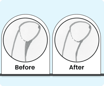 frenuloplasty