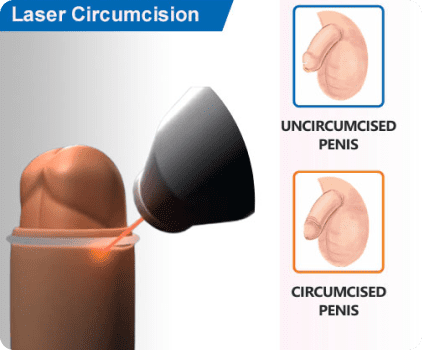 laser circumcision