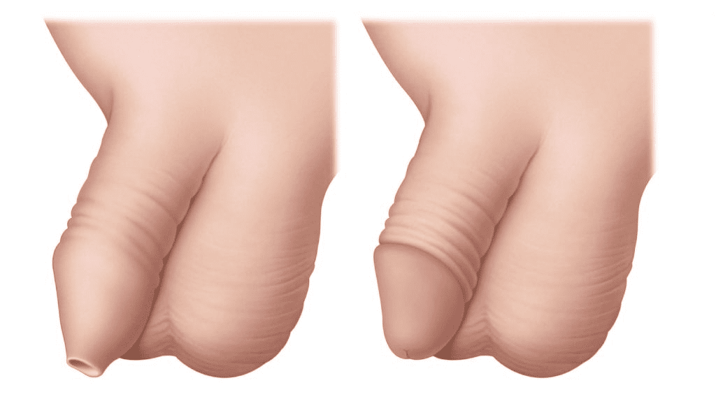 Circumcision surgery in Chandigarh