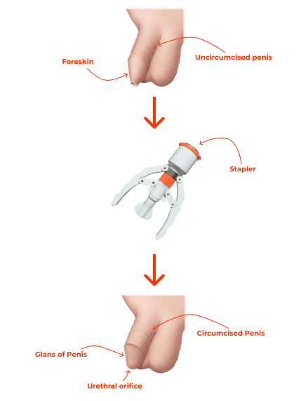 Circumcision surgery in Chandigarh