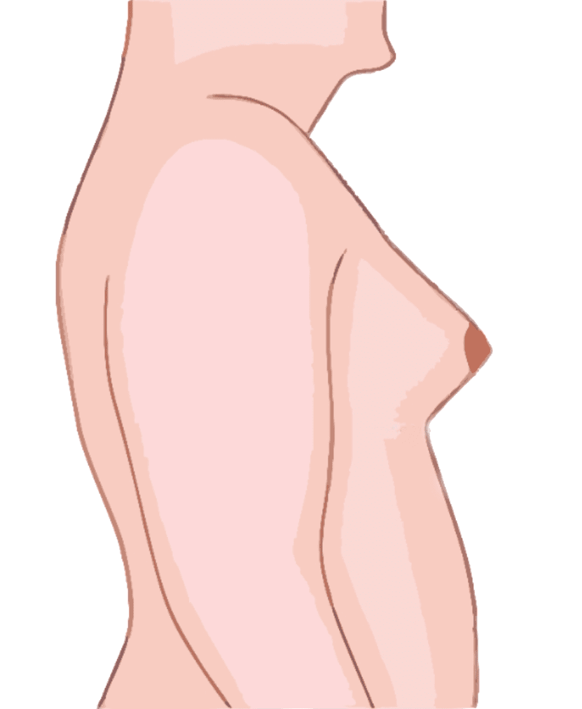 gynecomastia grade 1 hyderabad