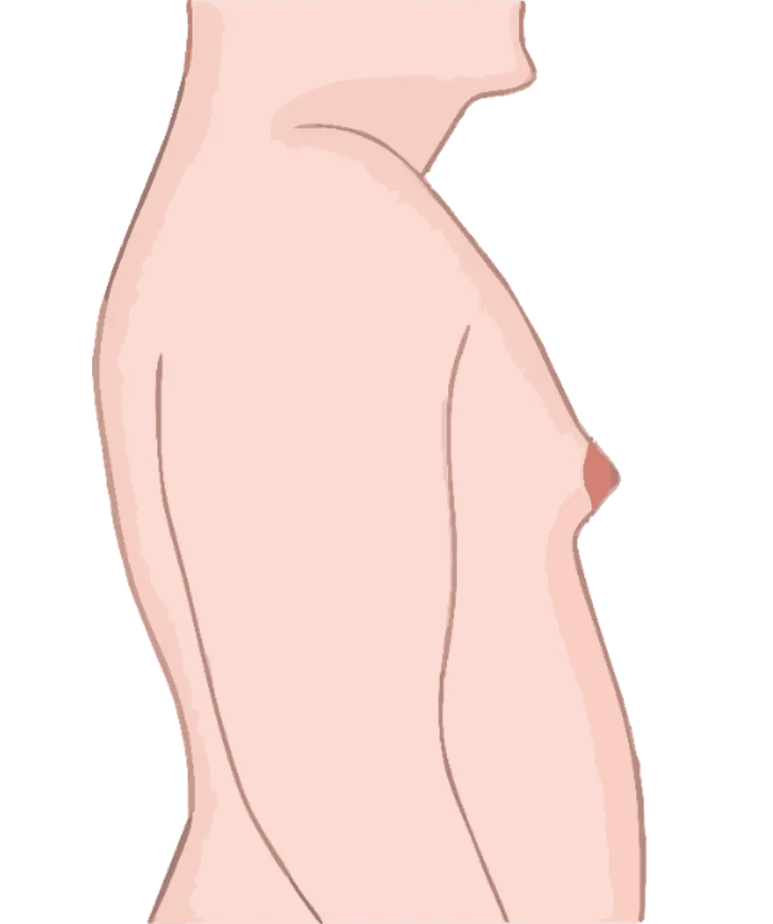 gynecomastia grade 2 hyderabad