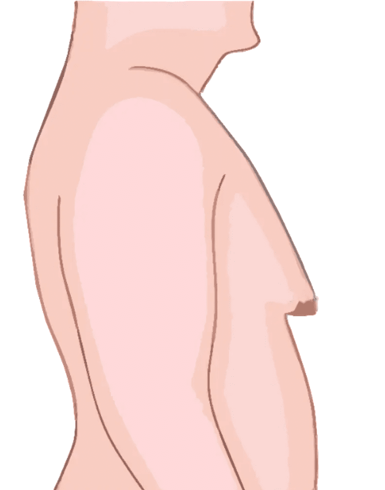 Gynecomastia Grade 3 Chandigarh