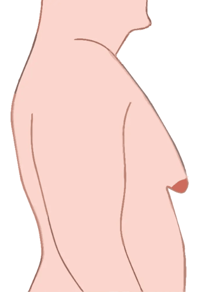 Gynecomastia Grade 4 Chandigarh