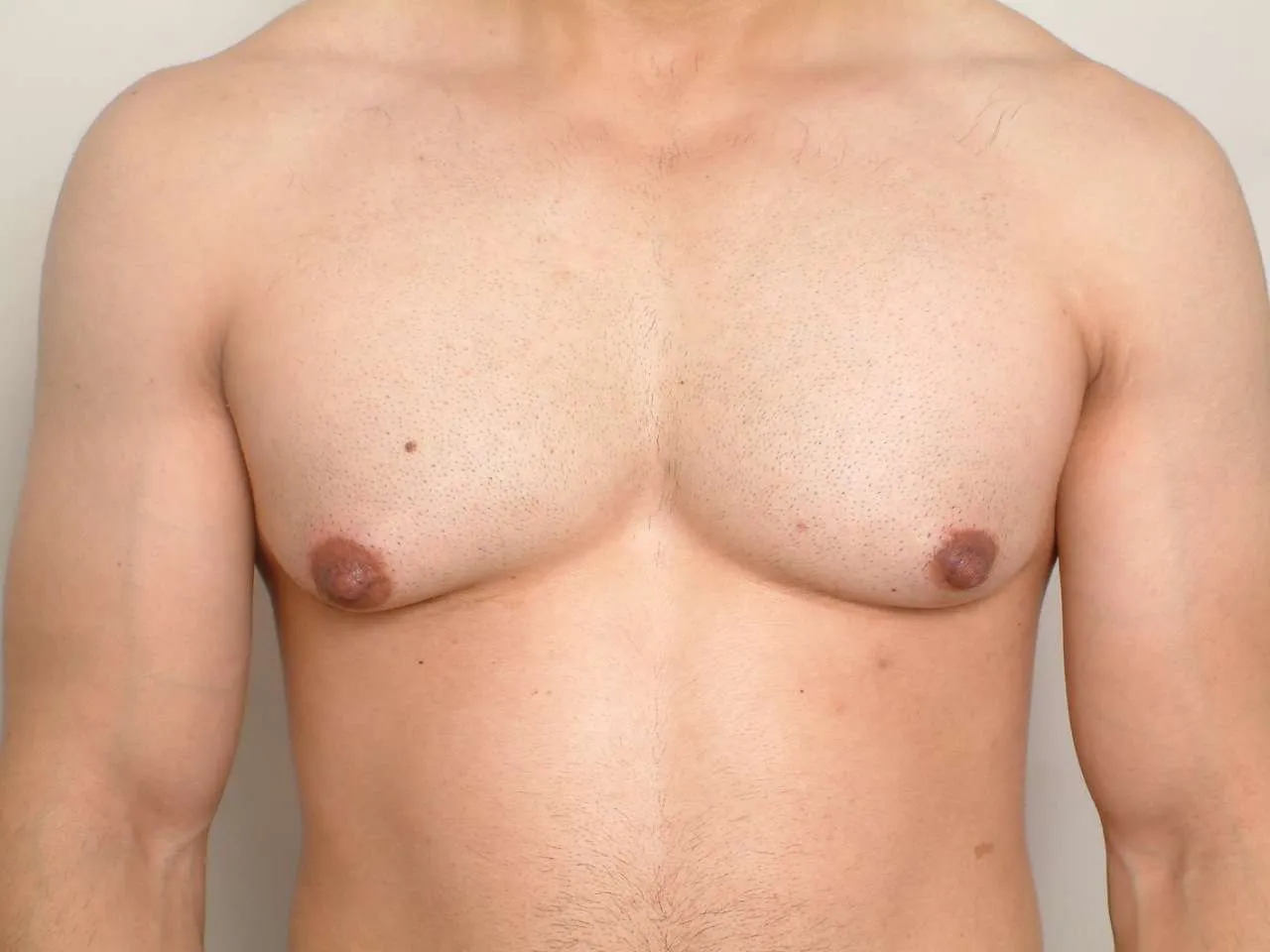 Gynecomastia Surgery in Hyderabad