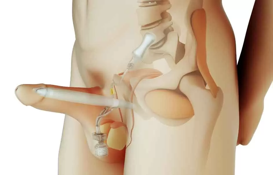 penile implant hyderabad
