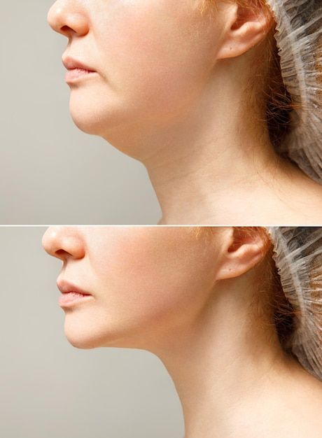 genioplasty in mumbai