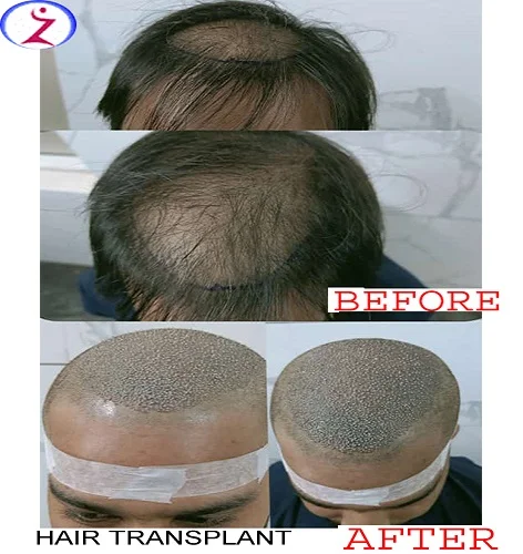 best hair transplant in indore