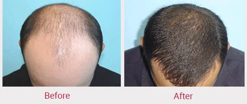 best hair transplant in indore