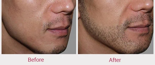 best hair transplant in indore