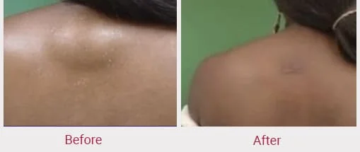 top lipoma removal doctors in India