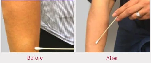 top lipoma removal doctors in India