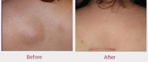 top lipoma removal doctors in India