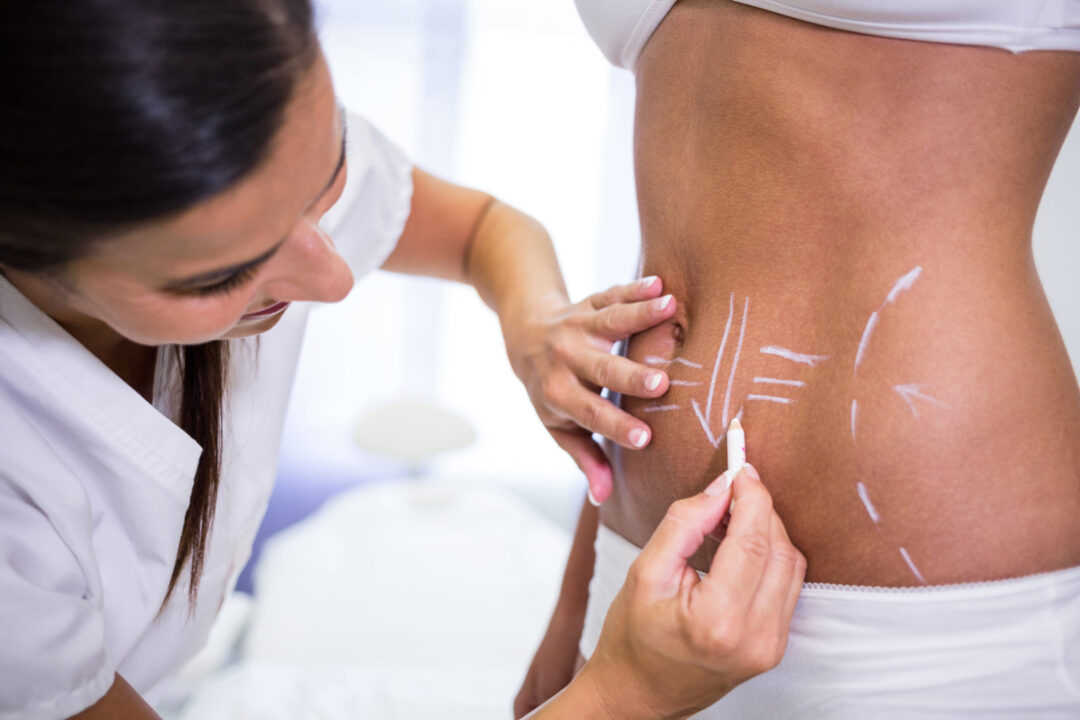 top liposuction surgeon in india