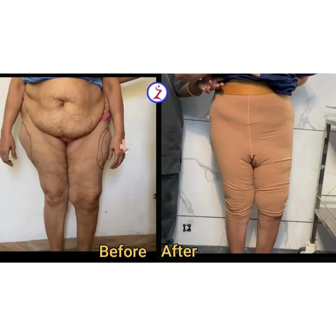 Best Liposuction Clinic in Hyderabad – Zenith Hospital