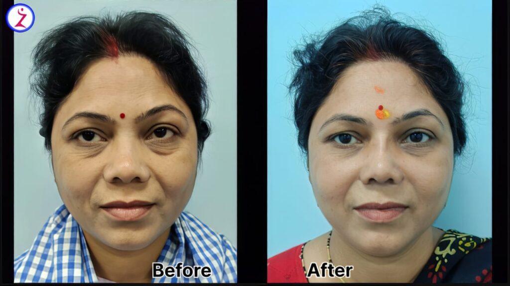 botox experts in Indore