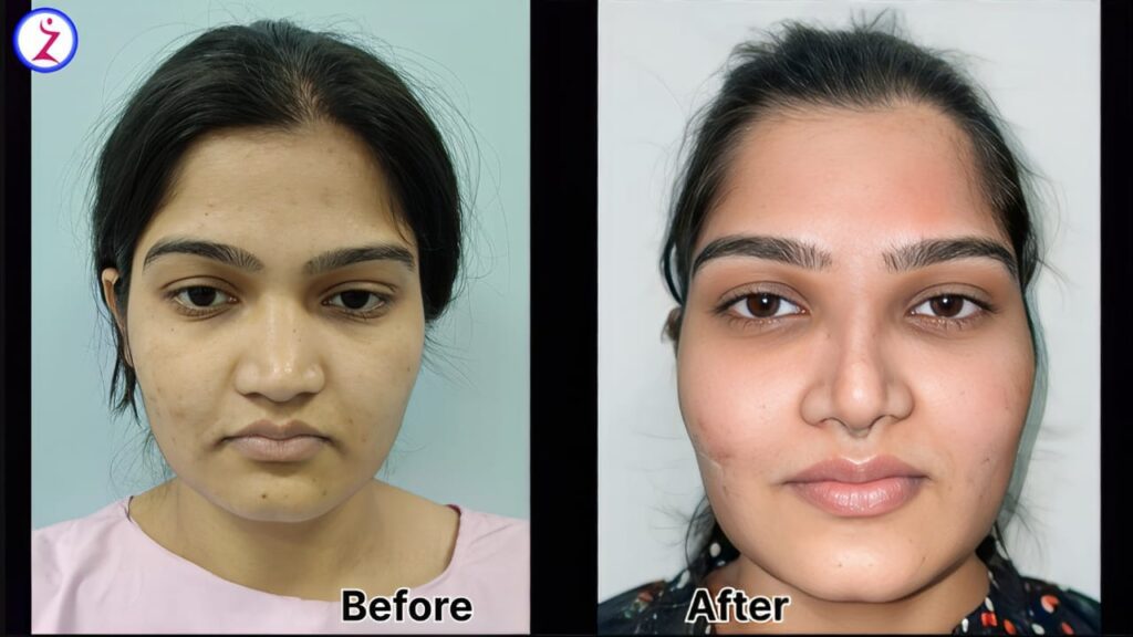 Top Rhinoplasty Hospital in Lucknow