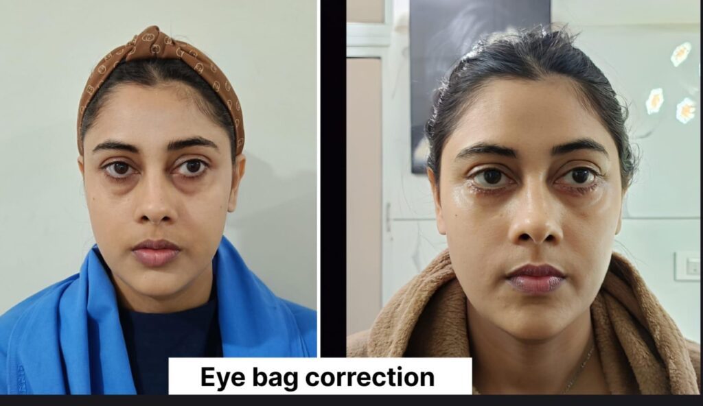 Blepharoplasty surgery in Indore