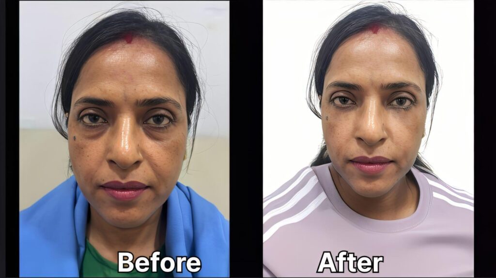 best facelift surgery in indore