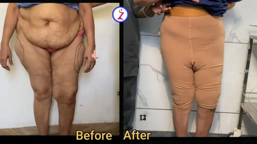 Best Liposuction Clinic in Kolkata 3 liposuction in bangalore