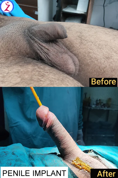 Penile implant treatment in Guwahati