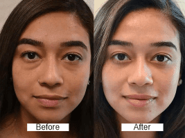 Facial Treatment