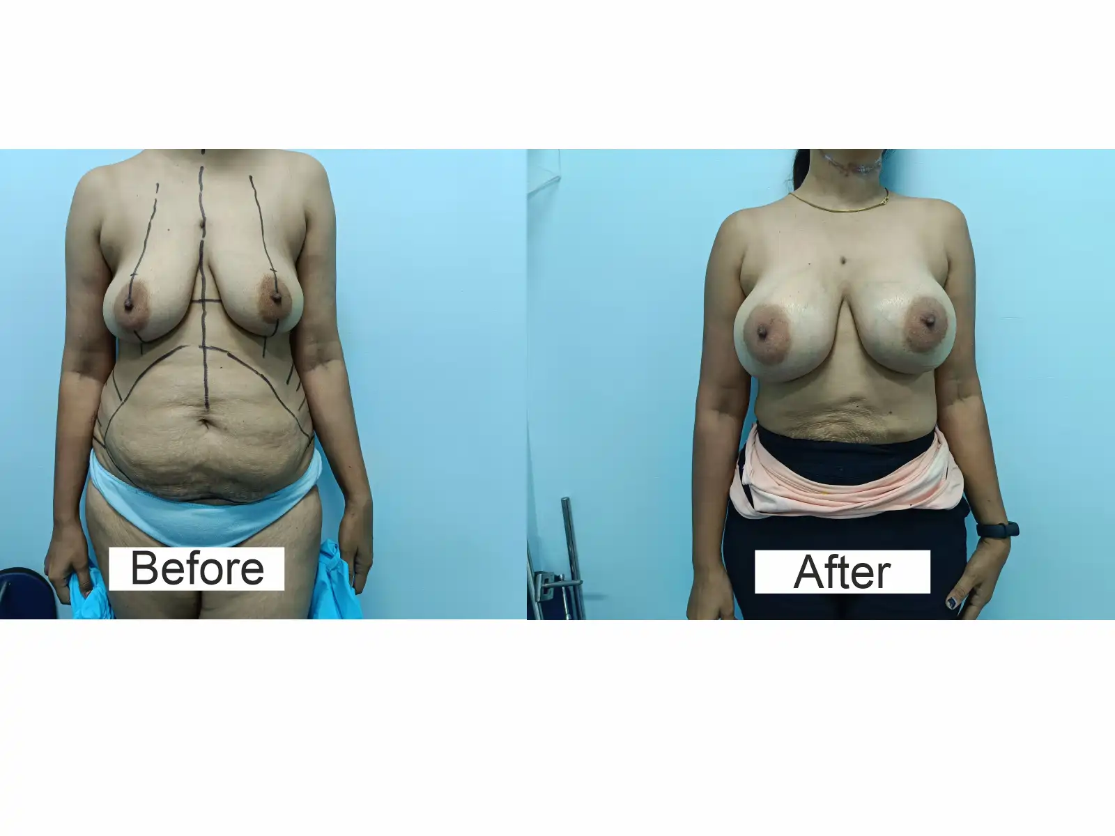 Home 18 breast implant