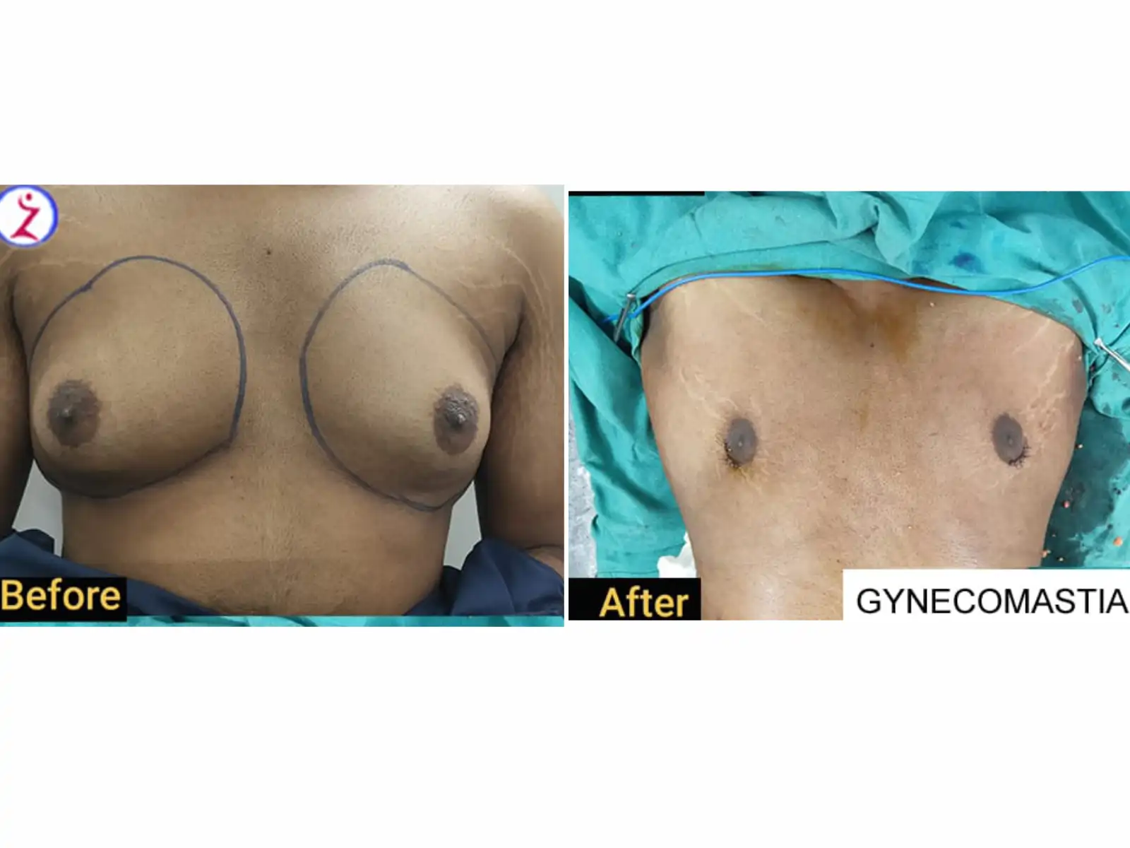 Home 15 gynecomastia