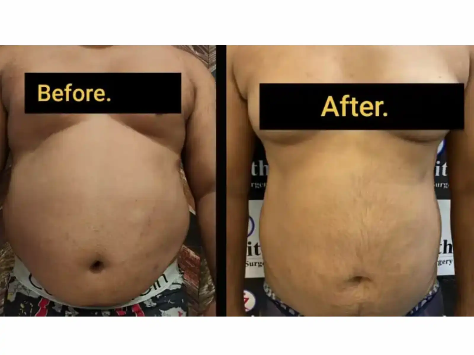 Home 14 liposuction