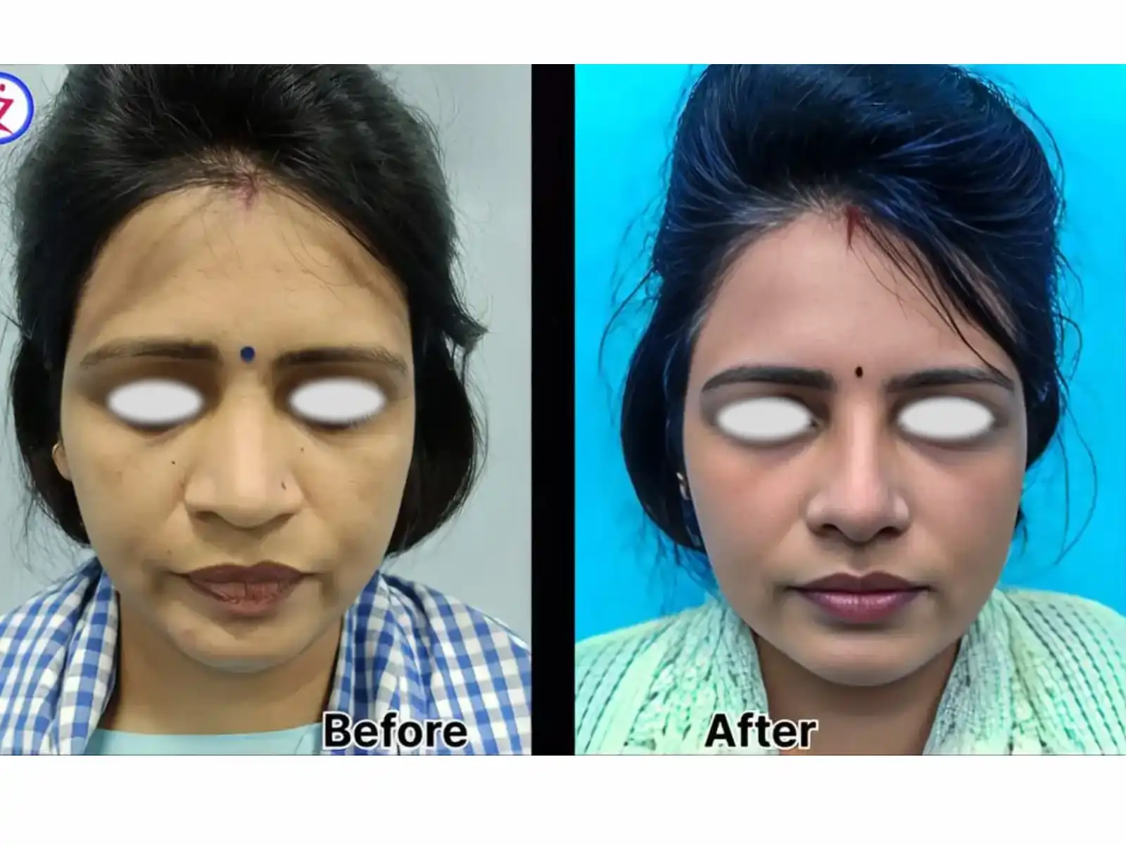 Home 16 rhinoplasty