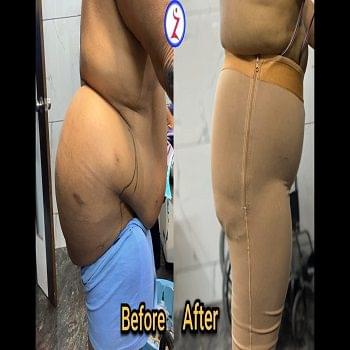 Best Liposuction Doctor in Bangalore