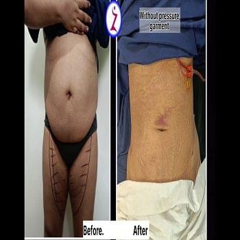 affordable liposuction in bangalore