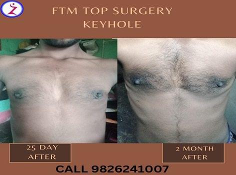 Gender change surgery in Ahmedabad