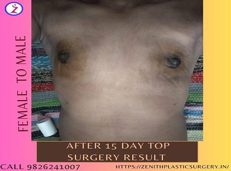 Gender change surgery in Ahmedabad
