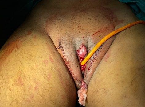 Gender change surgery in Ahmedabad